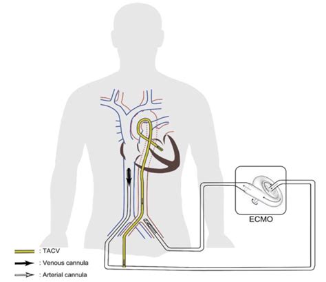 lv venting ecmo